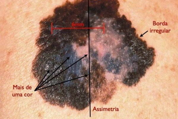 Melanoma X Melasma • Instituto Melanoma Brasil 